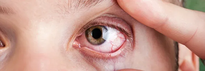 What Is Commonly Misdiagnosed as Pink Eye in Castle Rock CO?